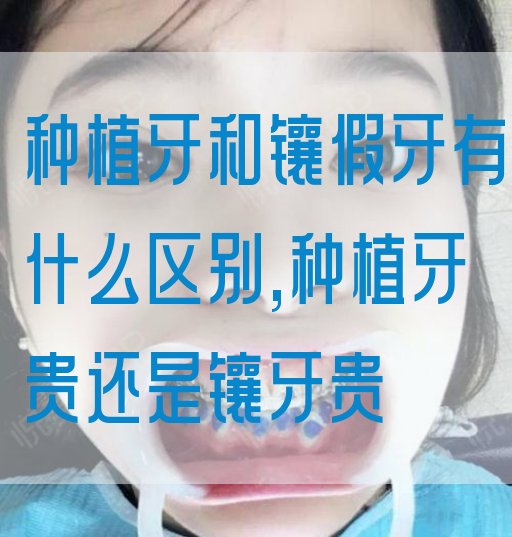 种植牙和镶假牙有什么区别,种植牙贵还是镶牙贵