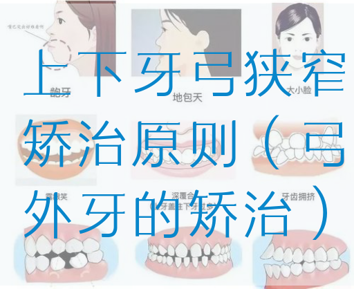 上下牙弓狭窄矫治原则（弓外牙的矫治）