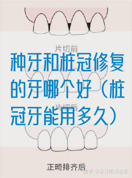 种牙和桩冠修复的牙哪个好（桩冠牙能用多久）