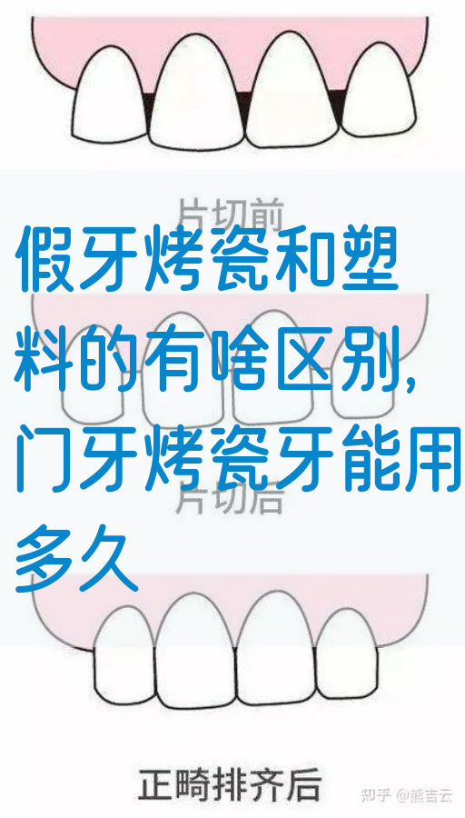 假牙烤瓷和塑料的有啥区别,门牙烤瓷牙能用多久