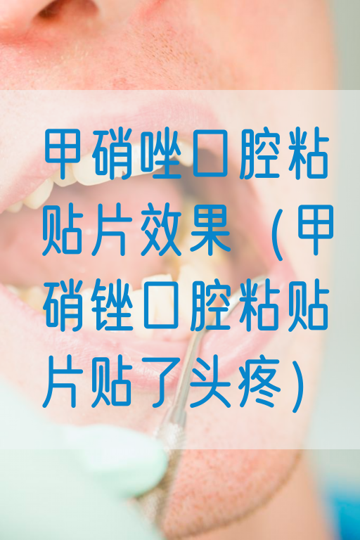 甲硝唑口腔粘贴片效果（甲硝锉口腔粘贴片贴了头疼）