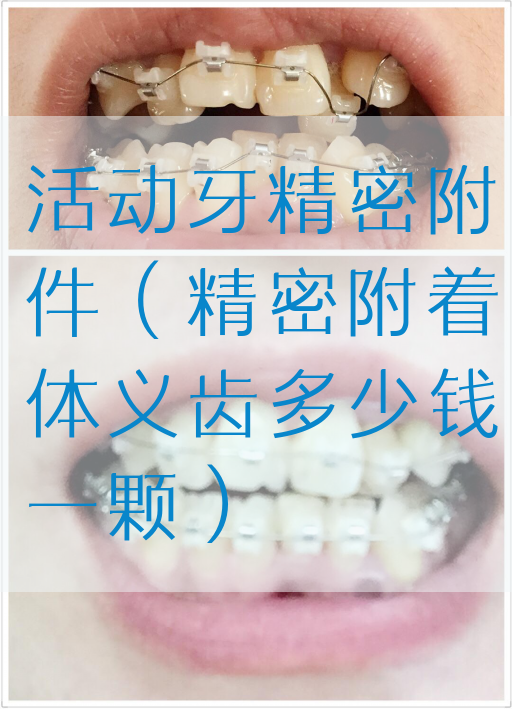 活动牙*密附件（*密附着体义齿多少钱一颗）