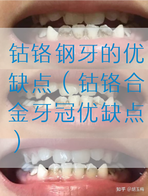 钴铬钢牙的优缺点（钴铬合金牙冠优缺点）