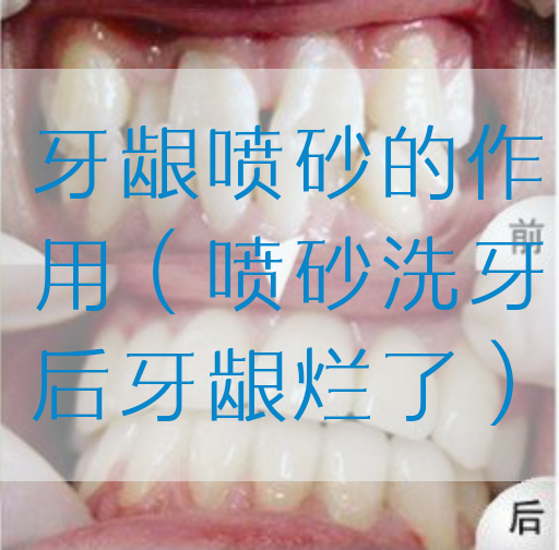 牙龈喷砂的作用（喷砂洗牙后牙龈烂了）