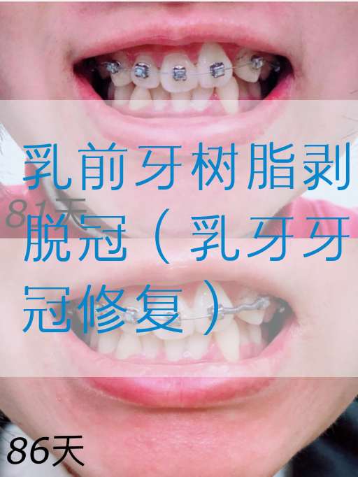 乳前牙树脂剥脱冠（乳牙牙冠修复）