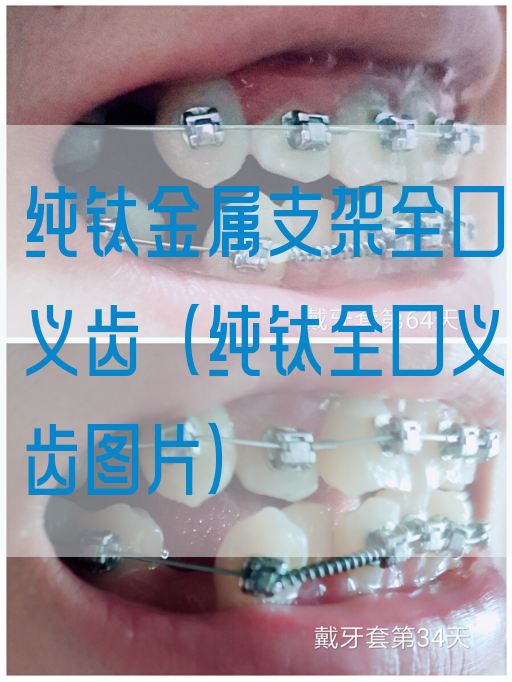 纯钛金属支架全口义齿（纯钛全口义齿图片）