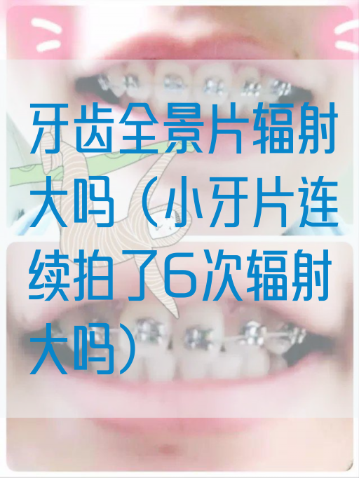 牙齿全景片辐射大吗（小牙片连续拍了6次辐射大吗）