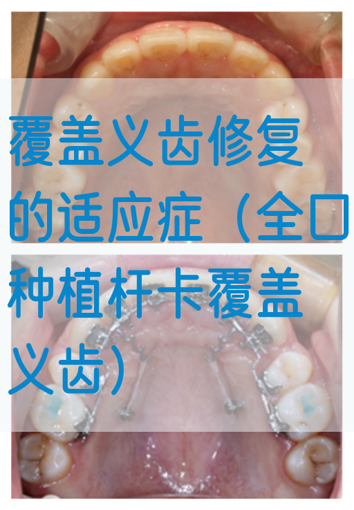 覆盖义齿修复的适应症（全口种植杆卡覆盖义齿）