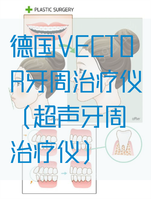 德国VECTOR牙周治疗仪（超声牙周治疗仪）