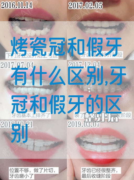 烤瓷冠和假牙有什么区别,牙冠和假牙的区别