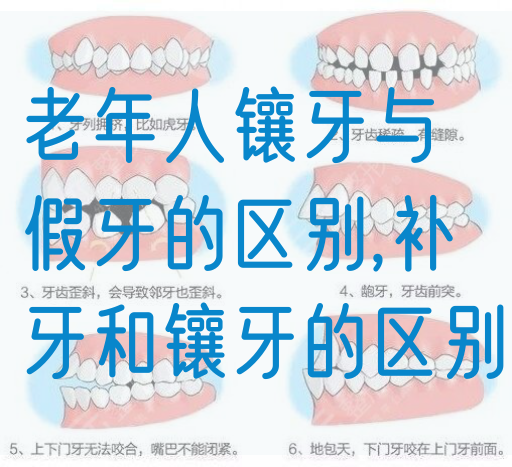 老年人镶牙与假牙的区别,补牙和镶牙的区别