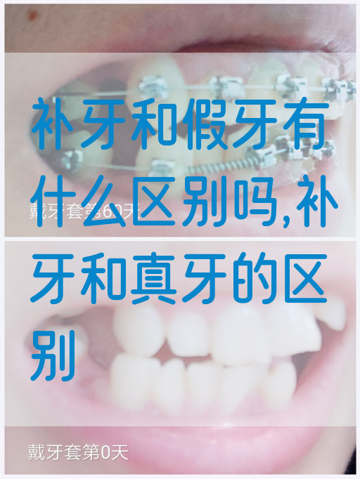 补牙和假牙有什么区别吗,补牙和真牙的区别