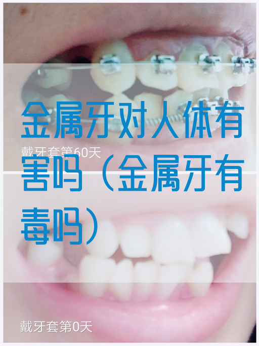 金属牙对人体有害吗（金属牙有毒吗）