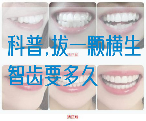 科普,拔一颗横生智齿要多久