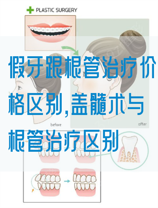 假牙跟根管治疗价格区别,盖髓术与根管治疗区别