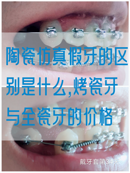 陶瓷仿真假牙的区别是什么,烤瓷牙与全瓷牙的价格