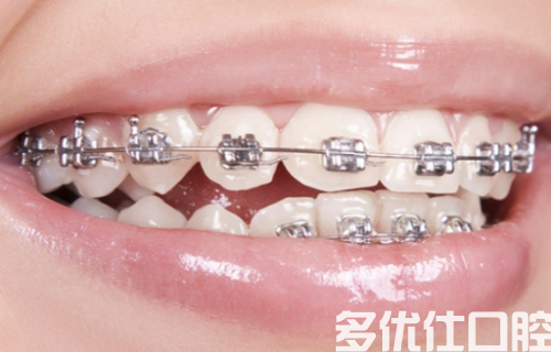 大连正畸哪个大夫比较好？附牙齿矫正项目价格表(图1)