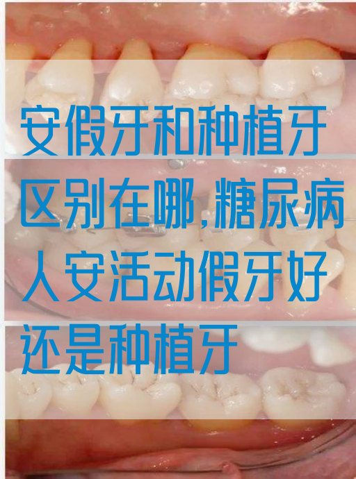安假牙和种植牙区别在哪,糖*病人安活动假牙好还是种植牙
