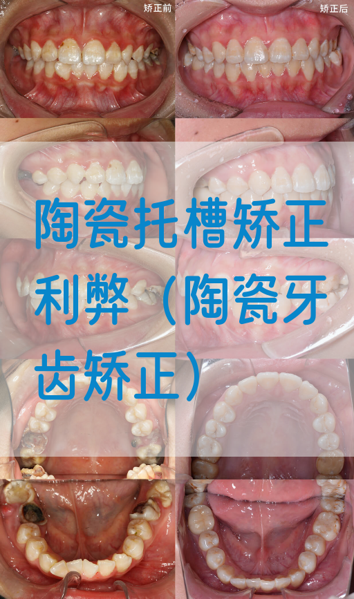 陶瓷托槽矫正利弊（陶瓷牙齿矫正）