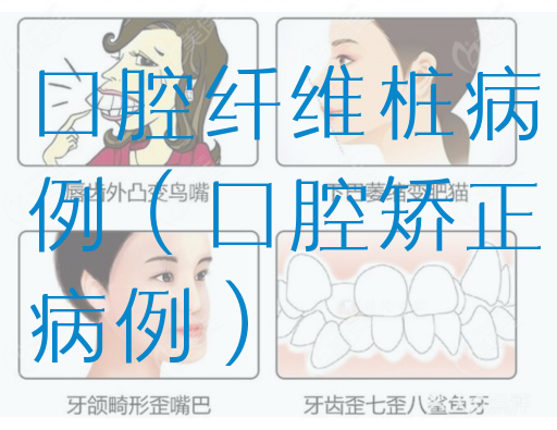 口腔纤维桩病例（口腔矫正病例）