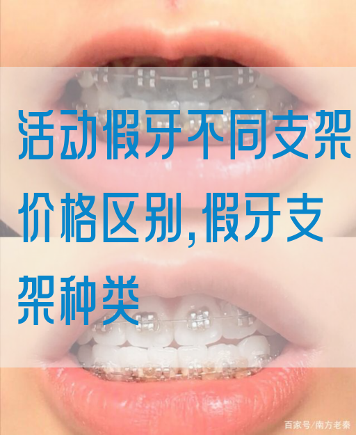 活动假牙不同支架价格区别,假牙支架种类