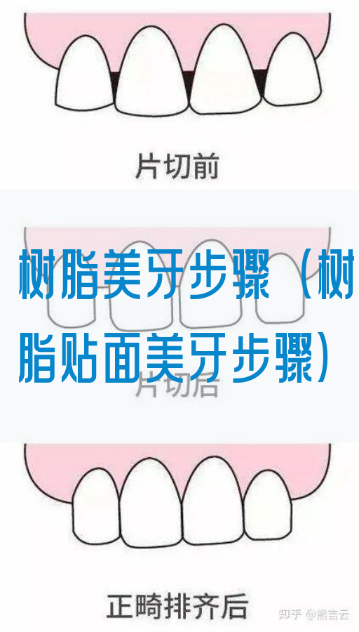 树脂美牙步骤（树脂贴面美牙步骤）