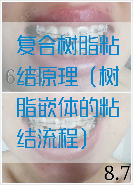 复合树脂粘结原理（树脂嵌体的粘结流程）
