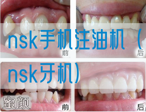 nsk手机注油机（nsk牙机）