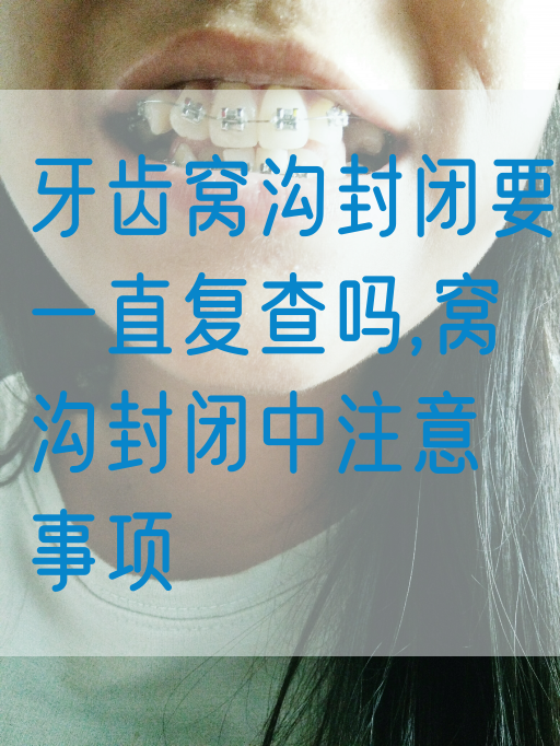 牙齿窝沟封闭要一直复查吗,窝沟封闭中注意事项