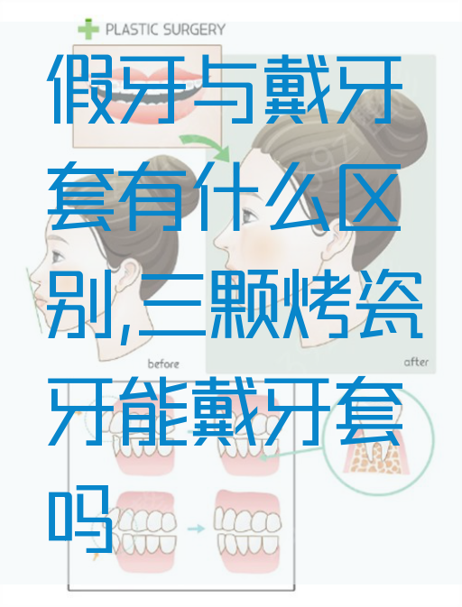 假牙与戴牙套有什么区别,三颗烤瓷牙能戴牙套吗