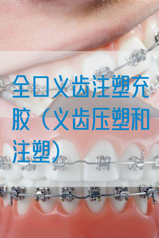 全口义齿注塑充胶（义齿压塑和注塑）