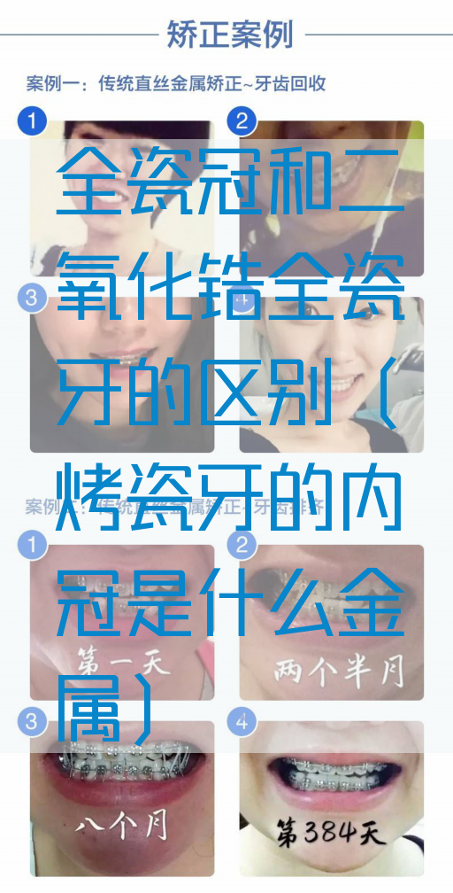 全瓷冠和二氧化锆全瓷牙的区别（烤瓷牙的内冠是什么金属）