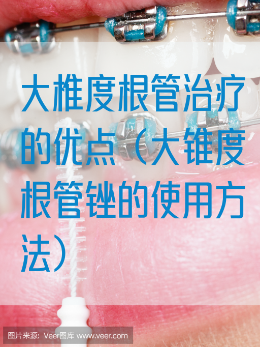 大椎度根管治疗的优点（大锥度根管锉的使用方法）