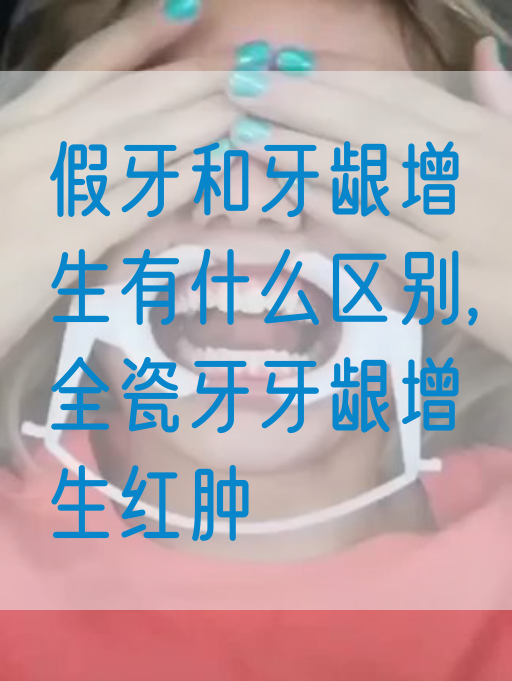 假牙和牙龈增生有什么区别,全瓷牙牙龈增生红肿