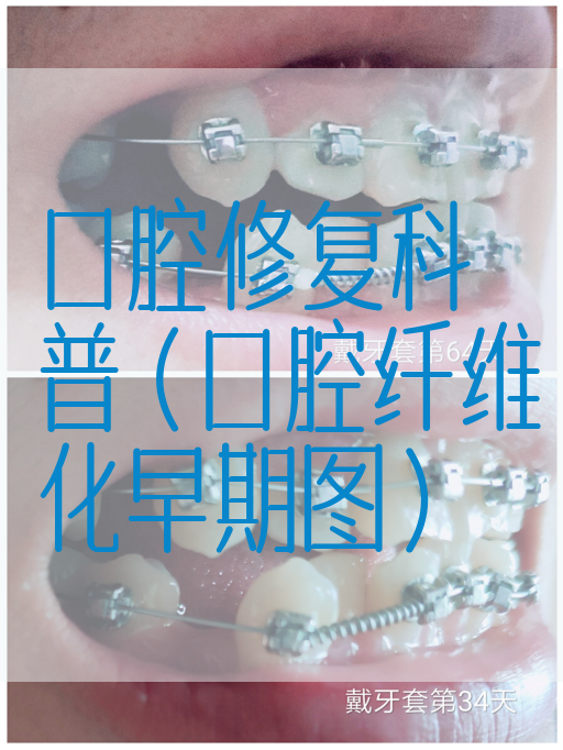 口腔修复科普（口腔纤维化早期图）