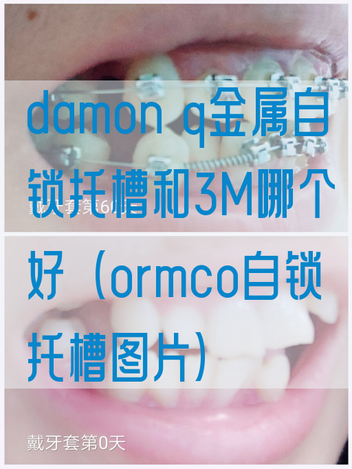 damon q金属自锁托槽和3M哪个好（ormco自锁托槽图片）