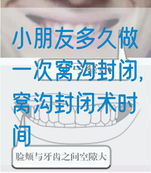 小朋友多久做一次窝沟封闭,窝沟封闭术时间