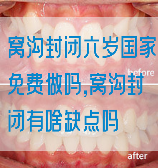 窝沟封闭六岁国家免费做吗,窝沟封闭有啥缺点吗