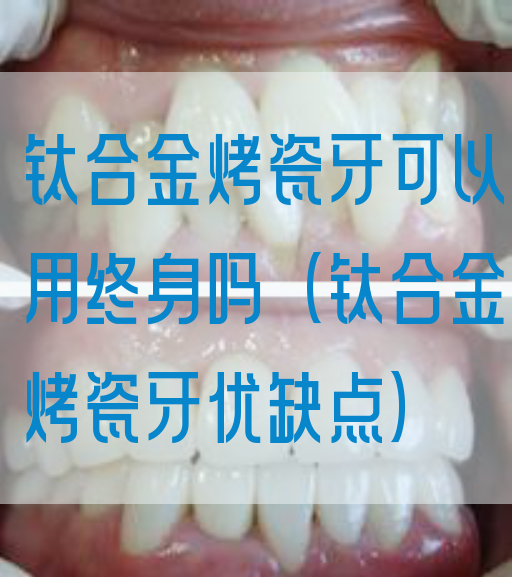 钛合金烤瓷牙可以用终身吗（钛合金烤瓷牙优缺点）
