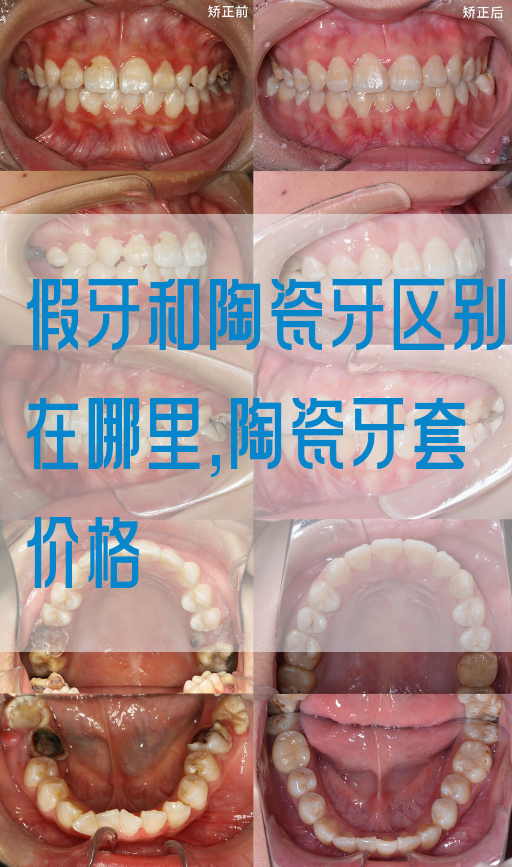 假牙和陶瓷牙区别在哪里,陶瓷牙套价格