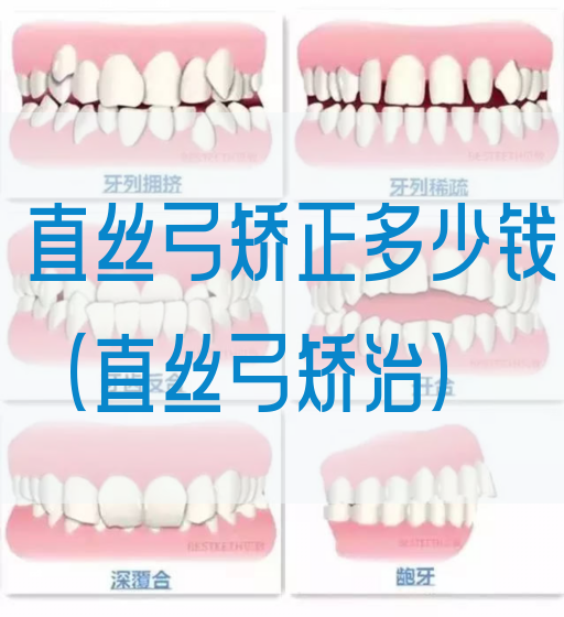 直丝弓矫正多少钱（直丝弓矫治）