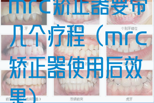 mrc矫正器要带几个疗程（mrc矫正器使用后效果）