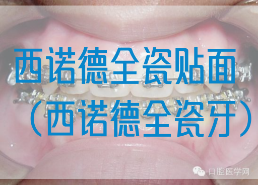 西诺德全瓷贴面（西诺德全瓷牙）