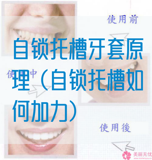 自锁托槽牙套原理（自锁托槽如何加力）