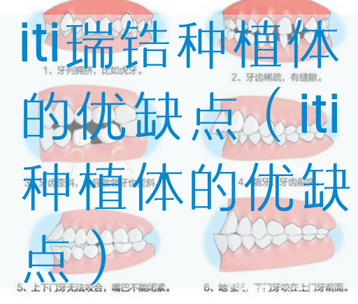 iti瑞锆种植体的优缺点（iti种植体的优缺点）