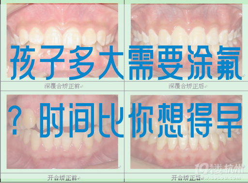 孩子多大需要涂氟？时间比你想得早