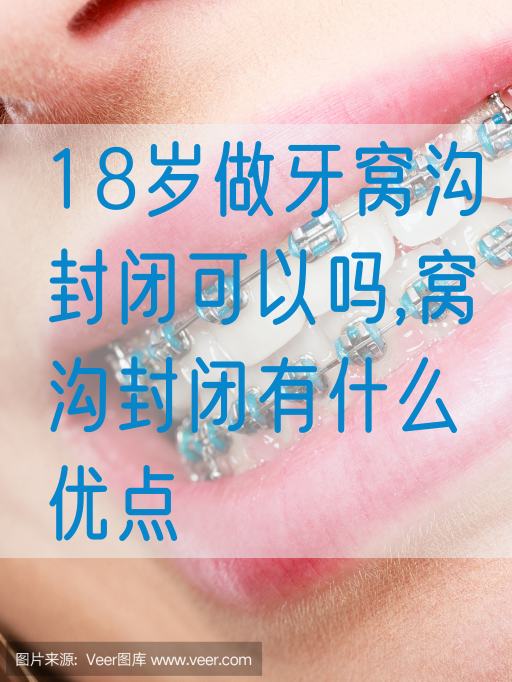 18岁做牙窝沟封闭可以吗,窝沟封闭有什么优点