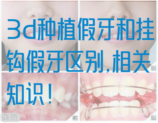 3d种植假牙和挂钩假牙区别,相关知识！