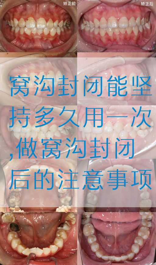 窝沟封闭能坚持多久用一次,做窝沟封闭后的注意事项