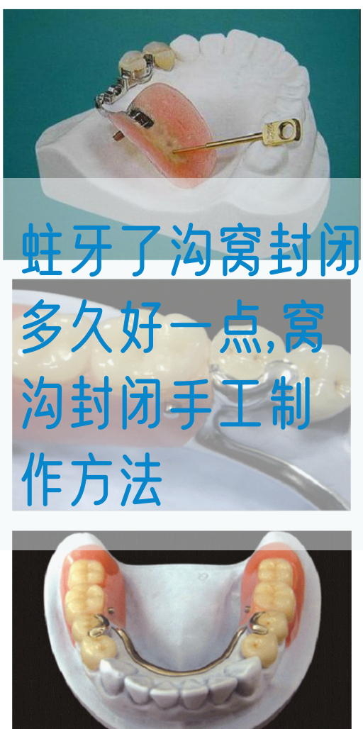 蛀牙了沟窝封闭多久好一点,窝沟封闭手工制作方法